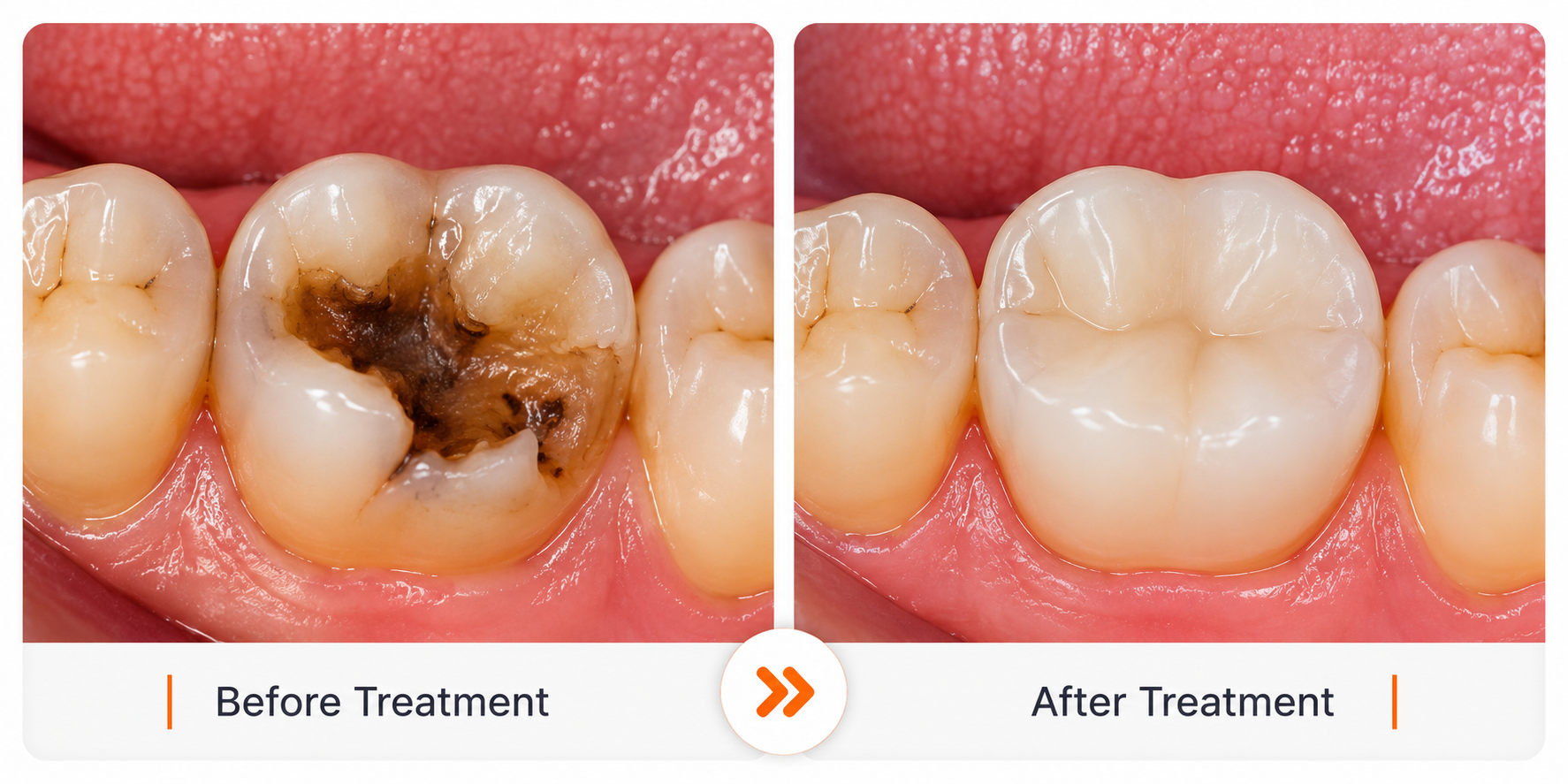 Before and After image of Root Canal Treatment